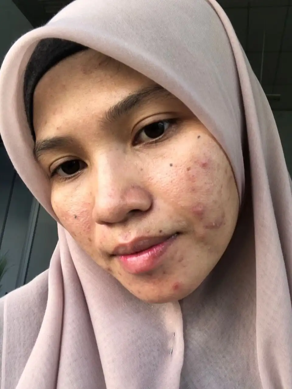 Dah try macam2 tapi hormonal acne susah giler nak hilang