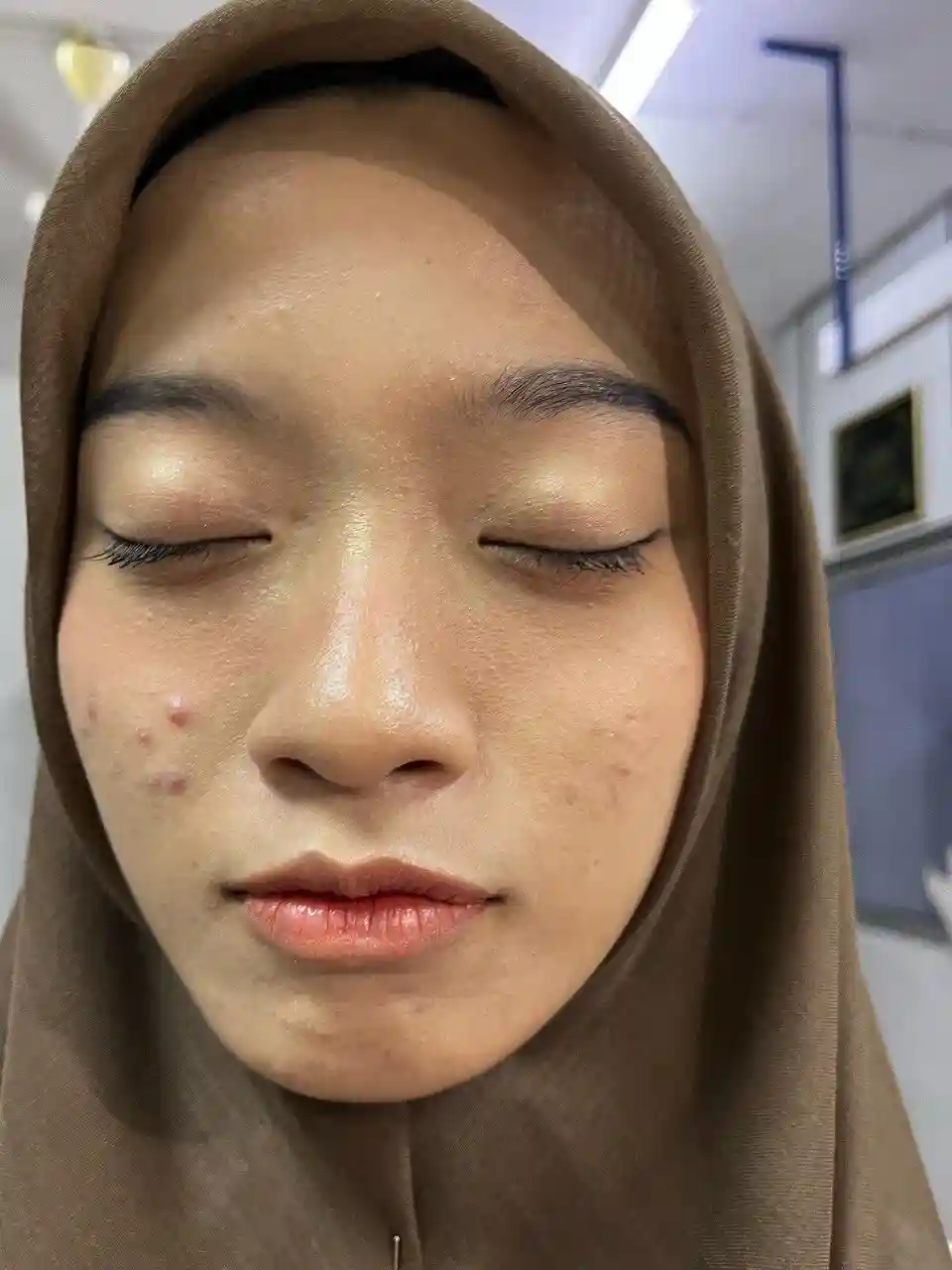 Pipi asyik naik jerawat seketul dua