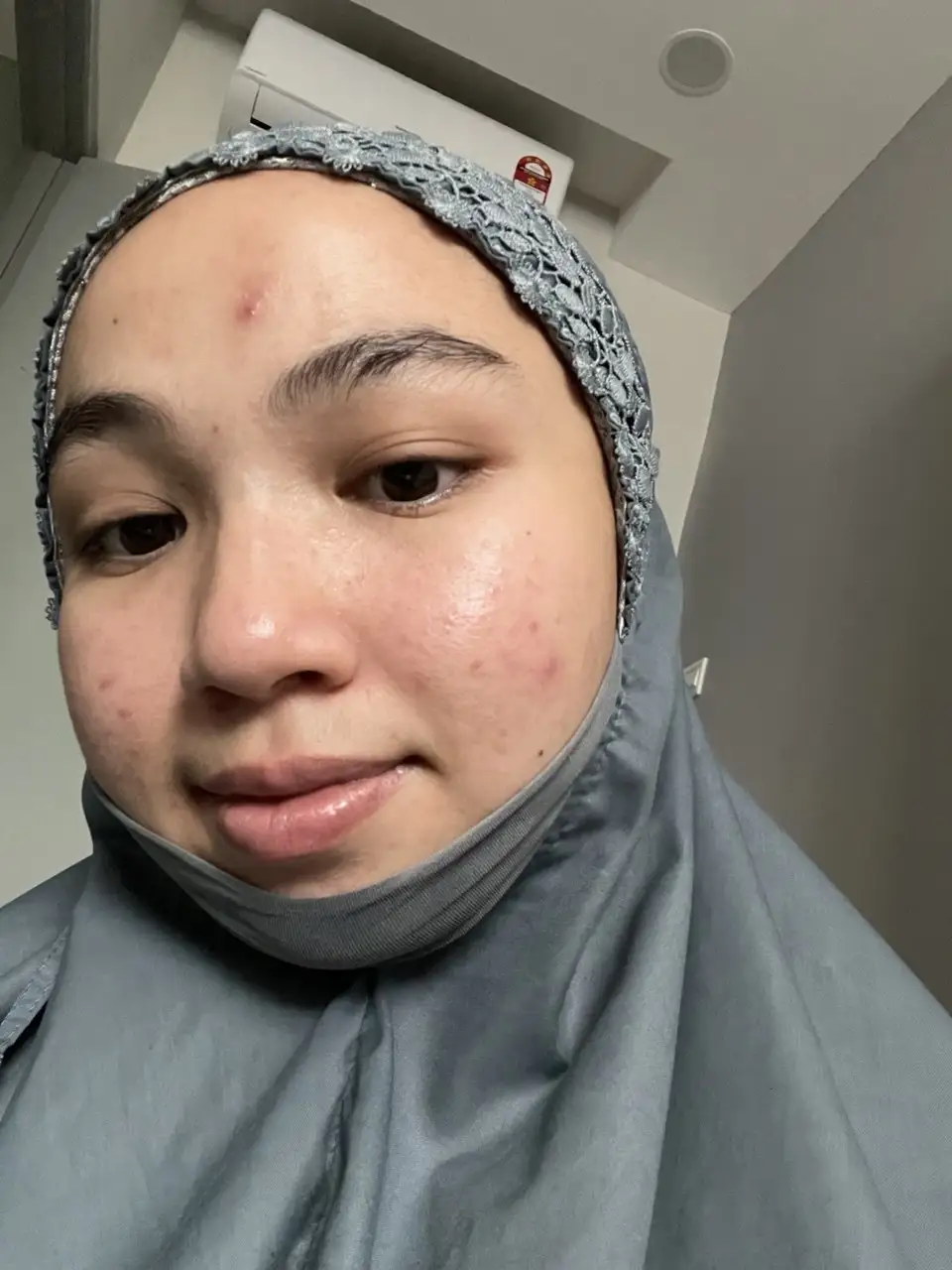 Pipi merah & parut degil tak surut.