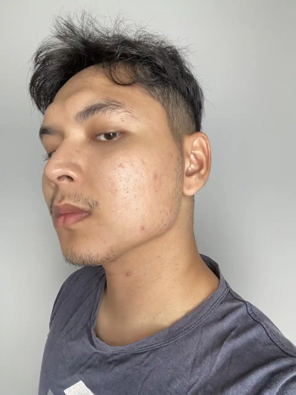 Jawline asyik naik jerawat batu.
